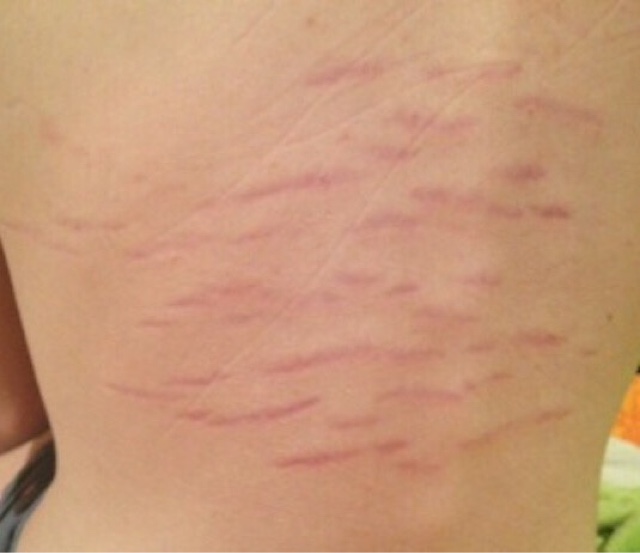 Bartonella (Kedi Tırmığı)